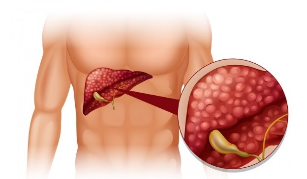 Fígado Saudável, Vida Saudável: Combatendo a Gordura no Fígado com a Dieta Prática